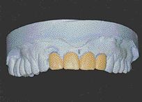 FIGURE 5B--Initial Waxup - no increase to length incisally.