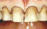 FIGURE 6--This 29-year-old patient presents with a complaint of multiple BPVRs de-bondiing. The six maxillary restorations were easily removed with a dental explorer to reveal the underlying tooth preparations. Prognosis for long-term resistance to micro-leakage and additional de-bonding for the replacement BPVRs is guarded.
