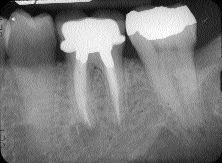 11D) One-year recall, lesion reduced in size, asymptomatic, tooth restored.