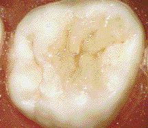 FIGURE 30--The final restoration after polishing and sealing.