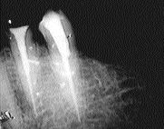 FIGURE 4--A retreatment of two lower premolars.