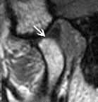FIGURE 6B - Open position (same patient). Disk remains normally positioned (arrow).