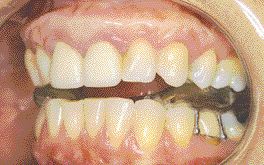 FIGURE 13--Repositioning splint.
