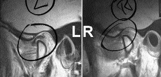 FIGURE 15--(R) Right TMJ MRI post-op. Note ideal disc/condyle arrangement. (L) Left TMJ MRI post-op. Note ideal disc/condyle arrangement.