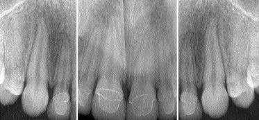 FIGURE 9--Radiographic confirmation of crown to root adaptation.