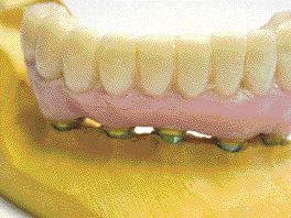 FIGURE 23--The temporary prosthesis was checked on the analog cast. The prosthesis was prepared without cantilevers to reduce stress-bearing forces on the implants.