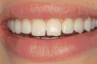 FIGURE 10--A smile of the female after one year of function with the canine implants.