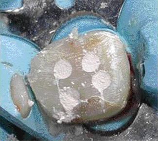 FIGURE 11--Temporary filling material has been placed into each orifice, over the shortened projectors.