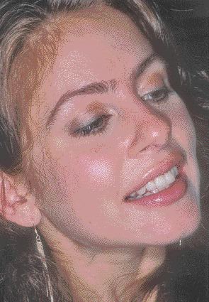 FIGURE 7--Pleased patient with her new veneers on her centrals.