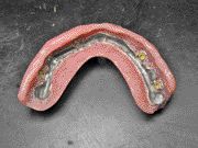 FIGURE 20--Intaglio surface of the prosthesis.