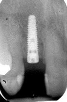 FIGURE 22--Implant radiograph.