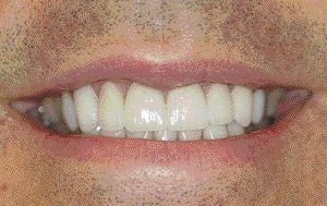FIGURES 13--Smile after veneers.