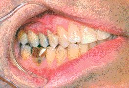 FIGURE 3--Root surfaces are covered with hybrid composite restorations, cord removed and the restorations finished and polished.