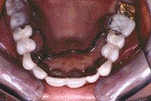 FIGURE 34--Occlusal view maxillary arch 1:2 post-op.
