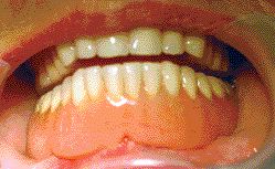 FIGURE10--Final delivery of the bar.