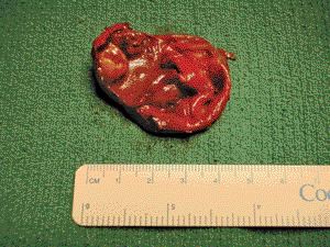 FIGURE 3B--Cyst opened to expose impacted tooth within.