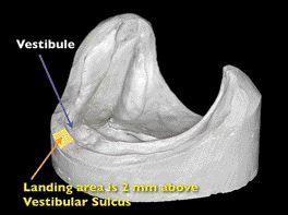 FIGURE 9B--Mandibular landing area 2mm above vestibular sulcus.