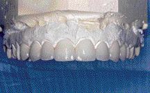 FIGURE 53--Porcelain Veneers on solid stone model.