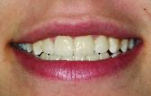 FIGURE 29--Final case 4 vibrant veneers.