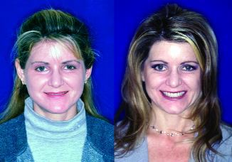FIGURE 11C--Before and after full face photos of full mouth reconstruction with increased vertical dimension creating more youthful appearance.