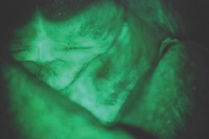 Figure 2. Intense dark area on the ridge as seen through VELscope examination persisted after relief of denture irritation. Biopsy confirmed severe dysplasia.