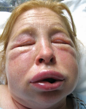 Figure 1--Angioedema due to the hereditary form of C1-esterase inhibitor deficiency.