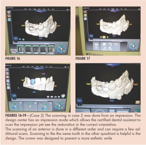 Figures 16-19--(Case 2) The scanning in case 2 was done from an impression. The design center has an impression mode which allows the certified dental assistant to scan the impression yet see the restoration in the correct orientation. The scanning of an anterior is done in a different order and can require a few additional scans. Scanning to the the same tooth in the other quadrant is helpful is the design. The crown was designed to present a more esthetic smile
