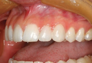 Figure 9--Post operative left lateral retracted view.