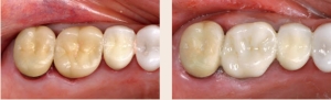 Figures 10 & 11--Deteriorating crown and Cerec 3D restoration