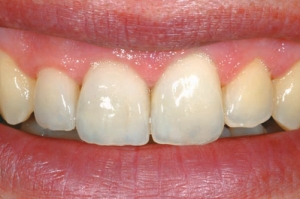 Figure 4--The patient's smile. Esthetics has been restored, in harmony with surrounding teeth, even if not in symmetry.