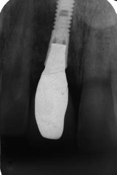 Figure 18--An unretracted smile view after completion of tooth number 9.