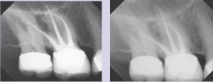Figures 10 & 11--Postoperative views after retreatment of #3. The MB2 canal is clearly visible in Figure 11.