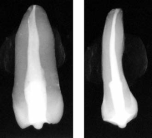 Figure 4--Radiograph of a bicuspid after obturation. Both plains are free of voids.
