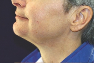 Figure 7b--Six month post-op follow-up lateral view.