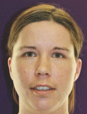 Figure 5--Post treatment presentation. Patient still has three remaining days of six week course of oral antibiotics as recommended by Infectious Disease.