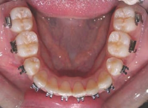 Figure 5--Clinical appearance prior to orthognathic surgery. The mandibular asymmetry and associated maxillary occlusal plane cant are evident. (Please note that photos in occlusion were taken in CR).