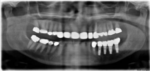 FIGURE 4--A panoramic radiograph from figures 2 and 3.