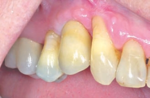FIGURE 40--The occlusion is checked, and light contact is developed in a strong bite with no occlusion at all in a gentle contact bite.