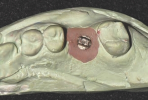 FIGURE 1A--The abutment and cast model of the cold-welded abutment.
