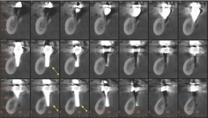 FIGURE 16--120 months post-treatment cone beam computed tomography (CBCT) scan, cross-sectional reformats, showing that the implants in the 47 (slice 58) and the 46 (slice 66) perforate the lingual plate. Yellow arrows indicate bone grafting material covering a portion of the apical aspect of these implants.
