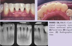 FIGURES 13A, B &C--Completed composite resin ribbon reinforced splint. (A) Facial view. (B) Lingual view. (C) Radiographic view.