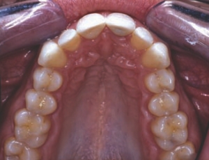 FIGURE 31--Maxillary occlusal 1:2 post-op.
