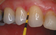 Figure 4-Pocket depth is measured pre treatment and 3 months post treatment.