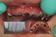 Figure 4-A very severe case of early childhood caries in a young child. Note the paruli present on the buccal gingiva of teeth 52 and 63. All maxillary anterior teeth are unrestorable and require extraction.