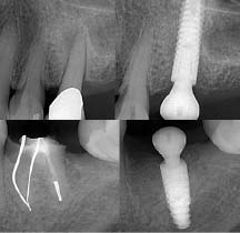 figure 12b-The expectation of a precise cone fixture-abutment connection is that the crestal bone will overgrow the fixture platform and remain in that position regardless of whether the implant was placed in a grafted site or immediately placed in an extraction site. Die-back or saucerization is not a consideration.