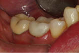 Figure 13--Immediate post op of the Natural 1 Crown cemented to place.