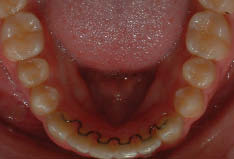 Figure 2 B-Maxillary and mandibular V-loop bonded lingual retainers