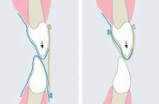 Figure 8-Schematic view of difference between Cow-Catch Clear Aligners (A) and a modified Cow-Catch Clear Aligner (B).