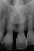 Figure 8- This radiograph taken 2 years after baseline reveals a decrease in the diastema as well as resolution of the angular defect on the mesial of 11 seen at baseline.