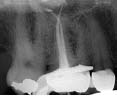 Figure 26-Case treated with PathFile and GTX. Post-operative radiograph (Courtesy of Dr. Stephen Buchanan, Santa Barbara, CA, USA).